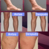 Parches Anti-Varices