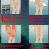 Parches Anti-Varices
